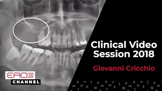 Graftless sinus floor elevation using a new implant design/ G.Cricchio / Clinical Video Session 2018