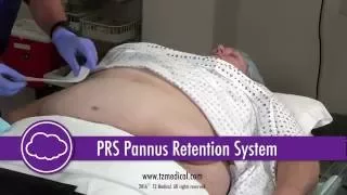 TZ Medical Pannus Retention System Application