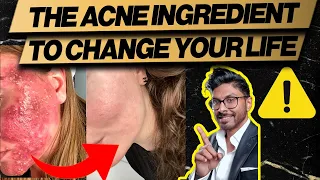 I use this ingredient to cure acne for all my patients