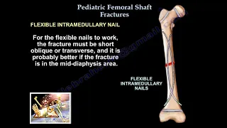 Pediatric Femoral Shaft Fractures - Everything You Need To Know - Dr. Nabil Ebraheim