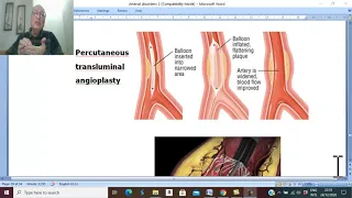 Arterial Disorders in Arabic 15 ( Chronic ischaemia , treatment 1 ) , by Dr. Wahdan .