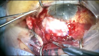 Buccal Membrane Transplant - Repair of Large Conjunctival Defect