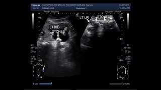 Multiple ureteric stones with multiple renal stones.