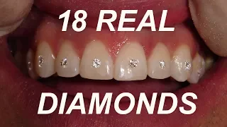 18 REAL DIAMONDS PUT IN TEETH TIME LAPSE