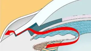 Normal Aqueous Drainage + Open-Angle Glaucoma + Glaucoma Filtering Surgery + Angle-Closure Glaucoma