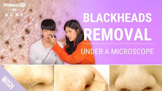 How to Remove Blackheads and NOT Enlarge Your Pores 👃 | Extreme close up of blackheads !