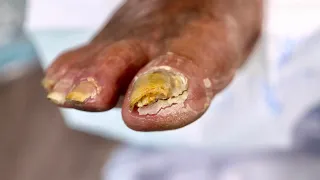 Super HIGH RISK...Super THICK TOENAIL TRIMMING