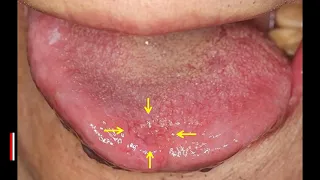 What causes tongue bumps