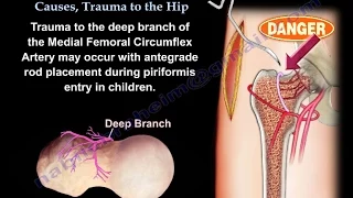 AVN Femoral Head  Causes, Trauma To The Hip - Everything You Need To Know - Dr. Nabil Ebraheim