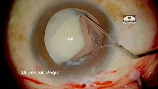 Mysteries of  Traumatic Cataract.- Dr Deepak Megur