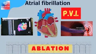 Atrial Fibrillation Ablation Procedure | Pulmonary Vein Isolation