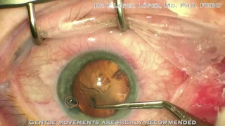 Capsulorhexis with zonular weakness