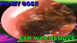 Huge Tonsil Stones Ear wax Removal in a case of Chronic Tonsillitis &How to ear wax- Spa-EP119