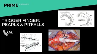 Trigger Finger: Pearls & Pifalls - Nikki Schroeder, MD