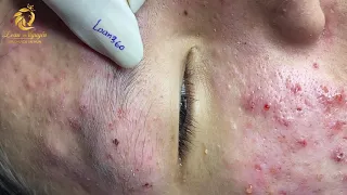 Treatment of acne tablets, pustules and blackheads (360) | Loan Nguyen