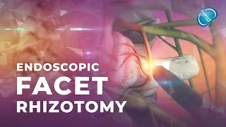 What is Endoscopic Facet Rhizotomy?