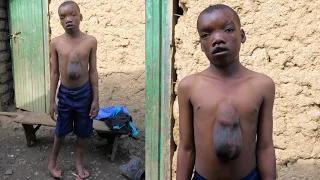 The Boy Born With Heart Outside His Chest Shocked Everyone : Extraordinary People