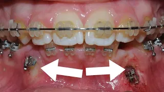 HOW #BRACES WORK - FOUR Impacted CANINES in a 👧 !