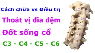 Cách chữa và điều trị thoát vị đĩa đệm đốt sống cổ c3 c4 c5 c6