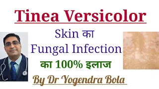 Tinea Versicolor (Skin Infection) ka 100% Treatment