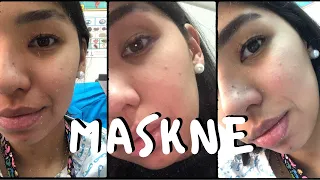 MASKNE: ¿Cómo prevenir el acné por uso de mascarillas?