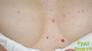 Красные капельки на коже живота, груди  -  Симптом Тужилина указывает на Панкреатит