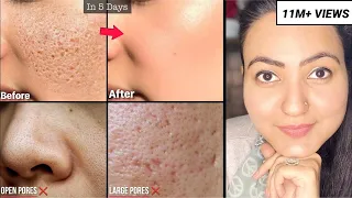 कितने भी पुराने OPEN PORES, LARGE PORES, CLOGGED PORES हों, इस Remedy से होगा 100% इलाज़