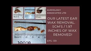 5CM/1.97IN OF EAR WAX REMOVED - EP 139