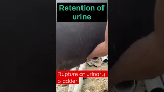 Rupture of urinary bladder l Retention of urine l Dr umar khan