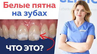 Причина белых пятен на зубах  Флюороз, гипоплазия эмали или кариес?