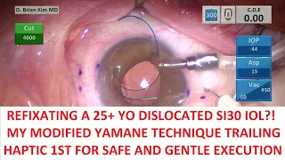 Refixate a 25+ Year Old Dislocated SI30 IOL?! My Trailing Haptic 1st Technique is Easier to Execute