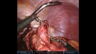 Robotic revision of the gastric bypass for weight re-gain