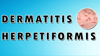 Dermatitis Herpetiformis Treatment, Causes, and Symptoms [Dermatology Course 21/60]