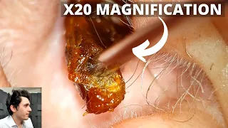 X20 Magnification Ear Wax Removal