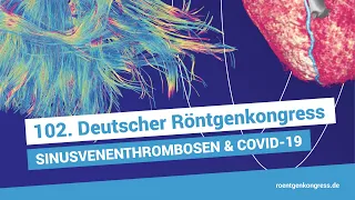 Sinusvenenthrombosen in Zeiten von COVID 19: Pathophysiologie, Diagnostik und Therapie