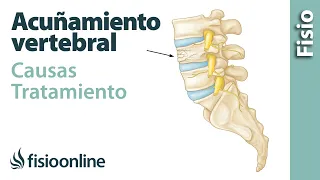 Fractura por acuñamiento vertebral - Qué es, causas, síntomas y tratamiento