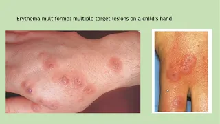 Lecture-41: Erythema Multiforme, SJ Syndrome and Toxic Epidermal Necrolysis. Rook's chapter 47,119.