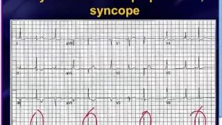 Mattu EKG Vakası: Senkopun EKG ile Ayırıcı Tanısı - 12 Ağustos 2013 Türkçe Altyazılı