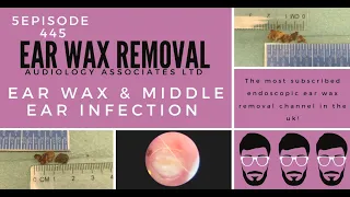 EAR WAX REMOVAL & MIDDLE EAR INFECTION - EP445