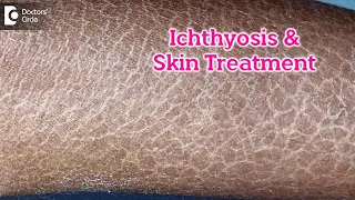 What is Ichthyosis? How to Treat my Skin?| Fish like scales On Skin-Dr.Rasya Dixit | Doctors' Circle