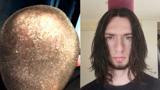 7 years no shampoo results