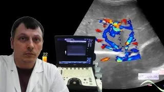 Pediatric abdomen and scrotum ultrasound - Portal hypertension