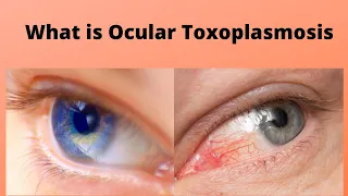 What is Ocular Toxoplasmosis