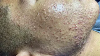 Acne Treatment For "Hung" (P4) | Điều Trị Mụn Cho Hùng (P4) -  SacDepSpa#189