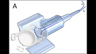 Modified 4 flanged technique