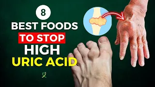 8 Best Foods To Stop High Uric Acid