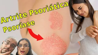 Psoríase e artrite psoriásica tem diferença? 5 dicas para você