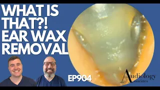 WHAT IS THAT?! EAR WAX REMOVAL - EP904