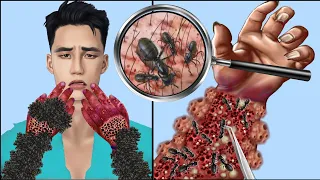 ASMR Remove Maggot & Ants Sting Infected Hand | Severely Injured Animation | Universe ASMR