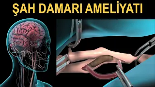 Şah Damarı (Karotis) Ameliyatı